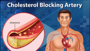Rimedi ed integratori per il colesterolo alto